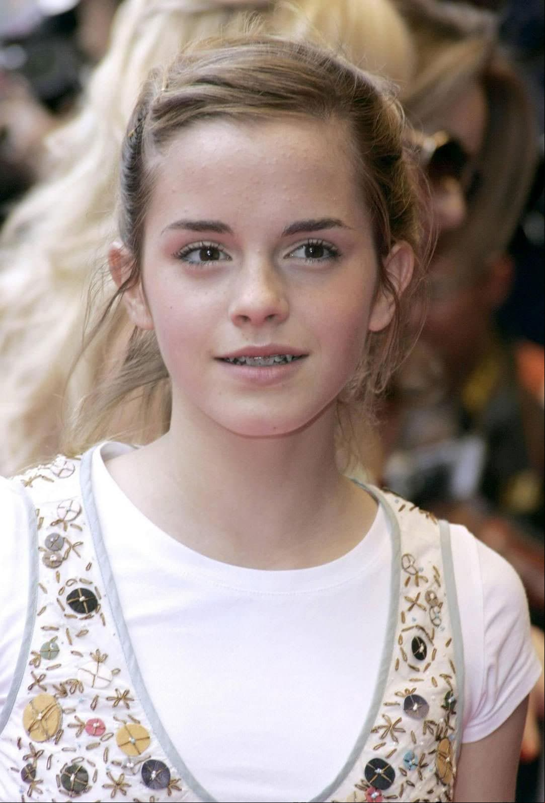 Mientras algunas personas deben utilizar aparatos dentales por años, Emma Watson los usó por cuatro meses cuando tenía 15 años, según la revista Seventeen.
