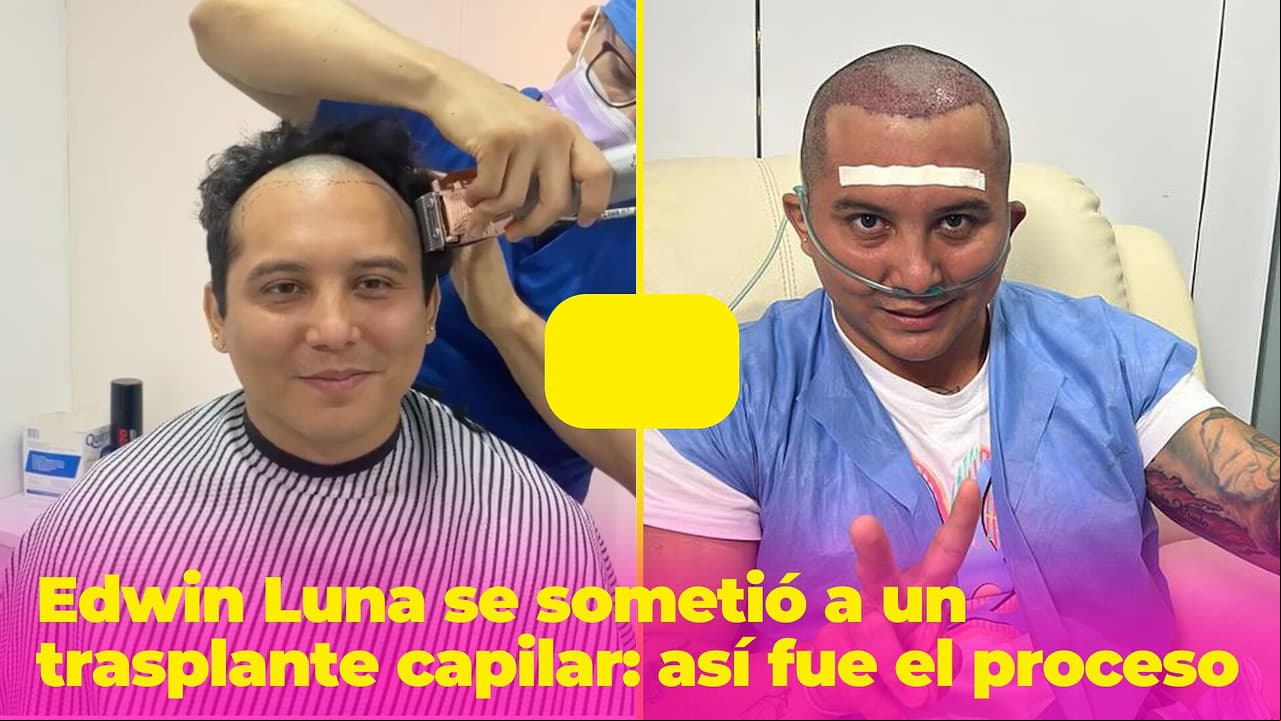 Edwin Luna se sometió a un trasplante capilar porque se "estaba quedando sin tierra en la maceta"
