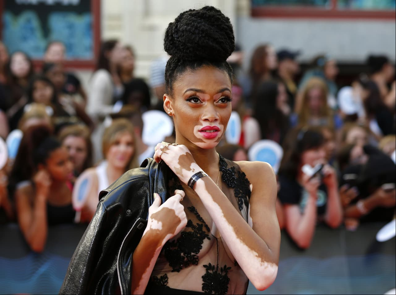 Winnie Harlow nació el 27 de julio de 1994 en Toronto, Ontario, Canadá, y se dedica al modelaje, además de ser vocera de la enfermedad que le afecta la piel llamada vitíligo, la cual se caracteriza por la aparición de manchas blancas de menor o mayor extensión en la piel.