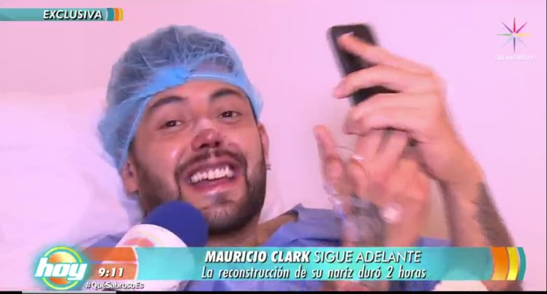 ¡Así luce Mauricio Clark tras reconstrucción nasal!