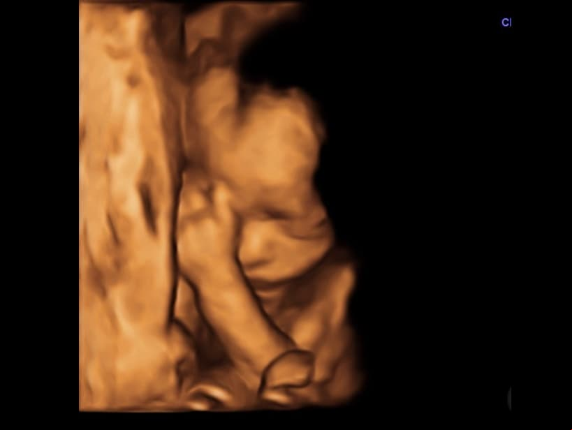 Un mes después, Marlene abrió una cuenta dedicada a su hija, compartiendo un ultrasonido de su semana 24, cuya imagen consiguió más de 13 mil likes.