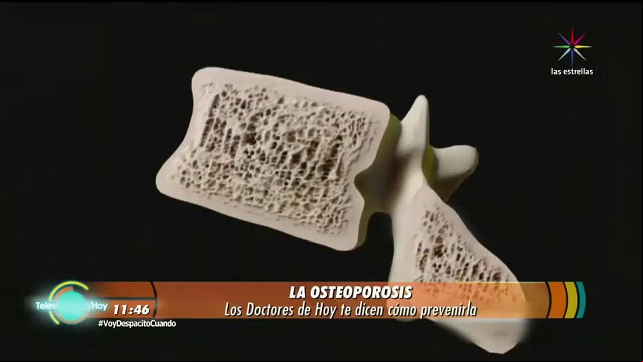 Los doctores de Hoy: Osteoporosis