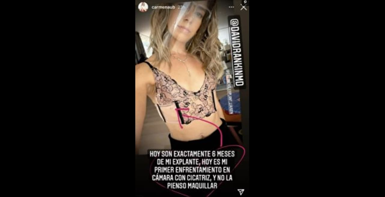 Carmen Aub muestra con orgullo la cicatriz que le quedó luego de quitarse los implantes de seno.