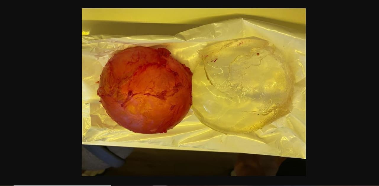 En otra más de sus publicaciones, incluso, exhibió los implantes para explicar que uno se le había reventando y enviar un contundente mensaje a sus seguidoras.