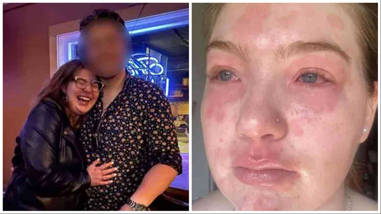Joven cree ser alérgica a su novio tras presentar extraños síntomas: se hace viral