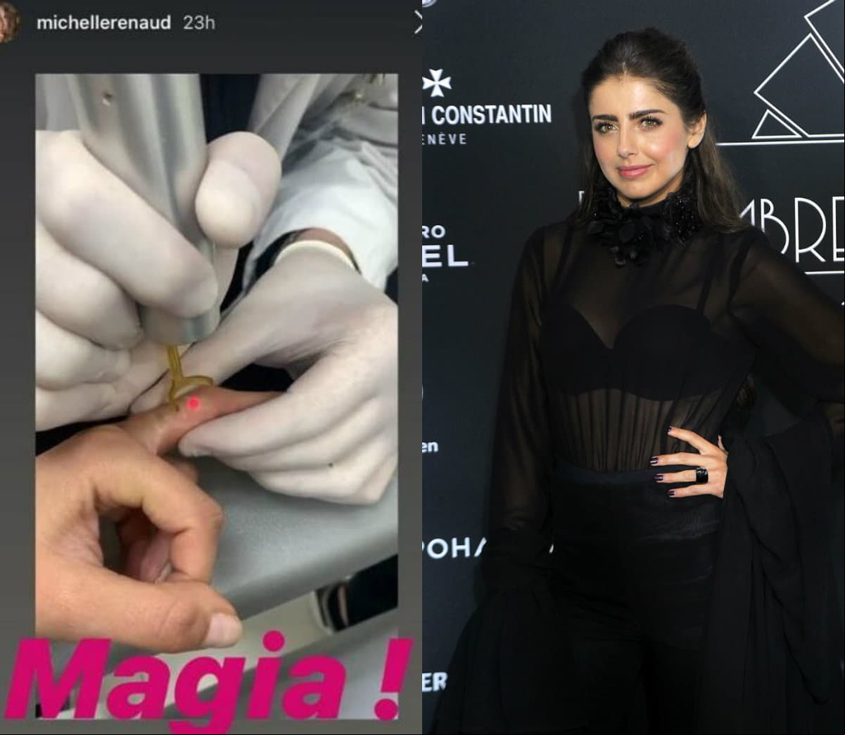 Hace unos días, Michelle Renaud mostró en redes sociales el procedimiento al que se sometió para retirarse tres tatuajes y afirmó que no le dolió, pero que le faltan dos sesiones más para borrarlos por completo. “Apenas va una sesión, se ve horrible esa cosa, pero me dijo el doc que al mes de mi primera sesión se va a caer esa costra y ya se va a ver cómo se quitó la pintura, que son tres sesiones aprox (…) No me dolió, el cambio es abismal”, detalló.
