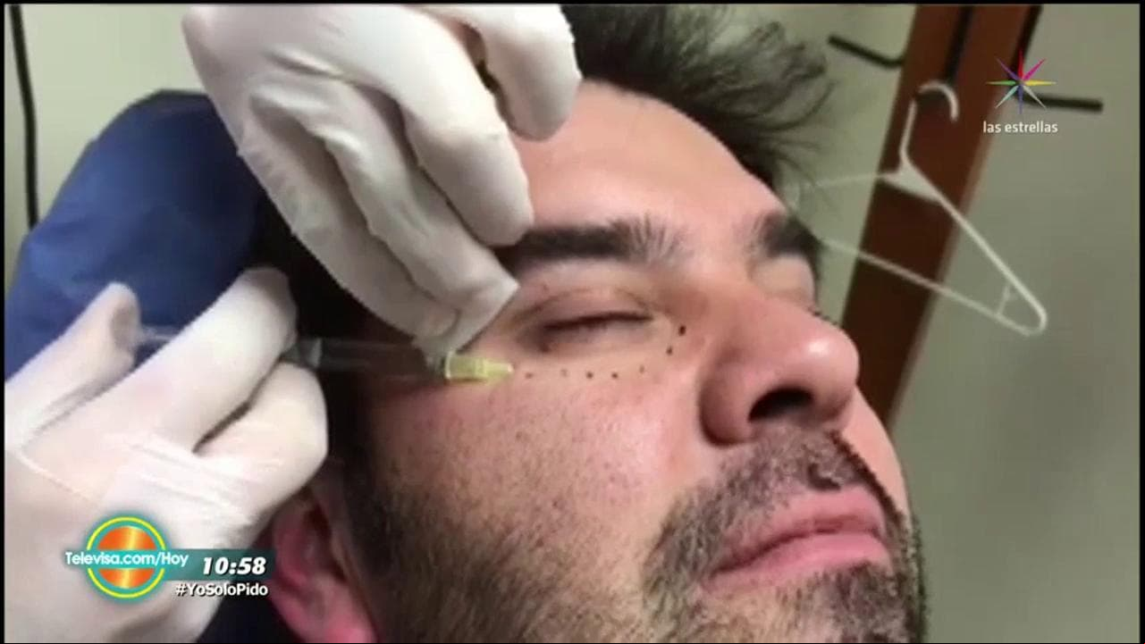 ¡Remoción de bolsas en los ojos!