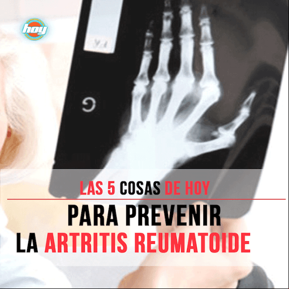 Checa cómo prevenir la artritis reumatoide