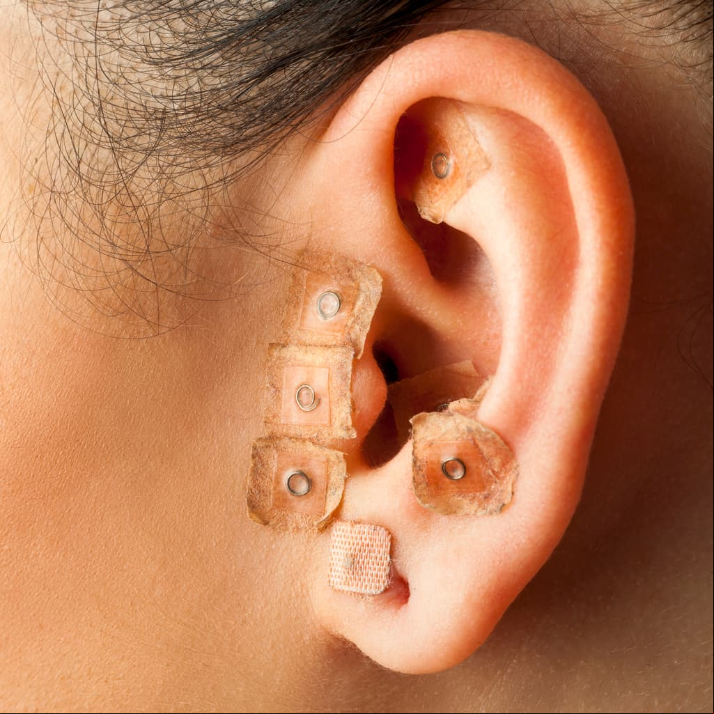 ¿Cómo funciona la auriculoterapia para perder peso y adelgazar?