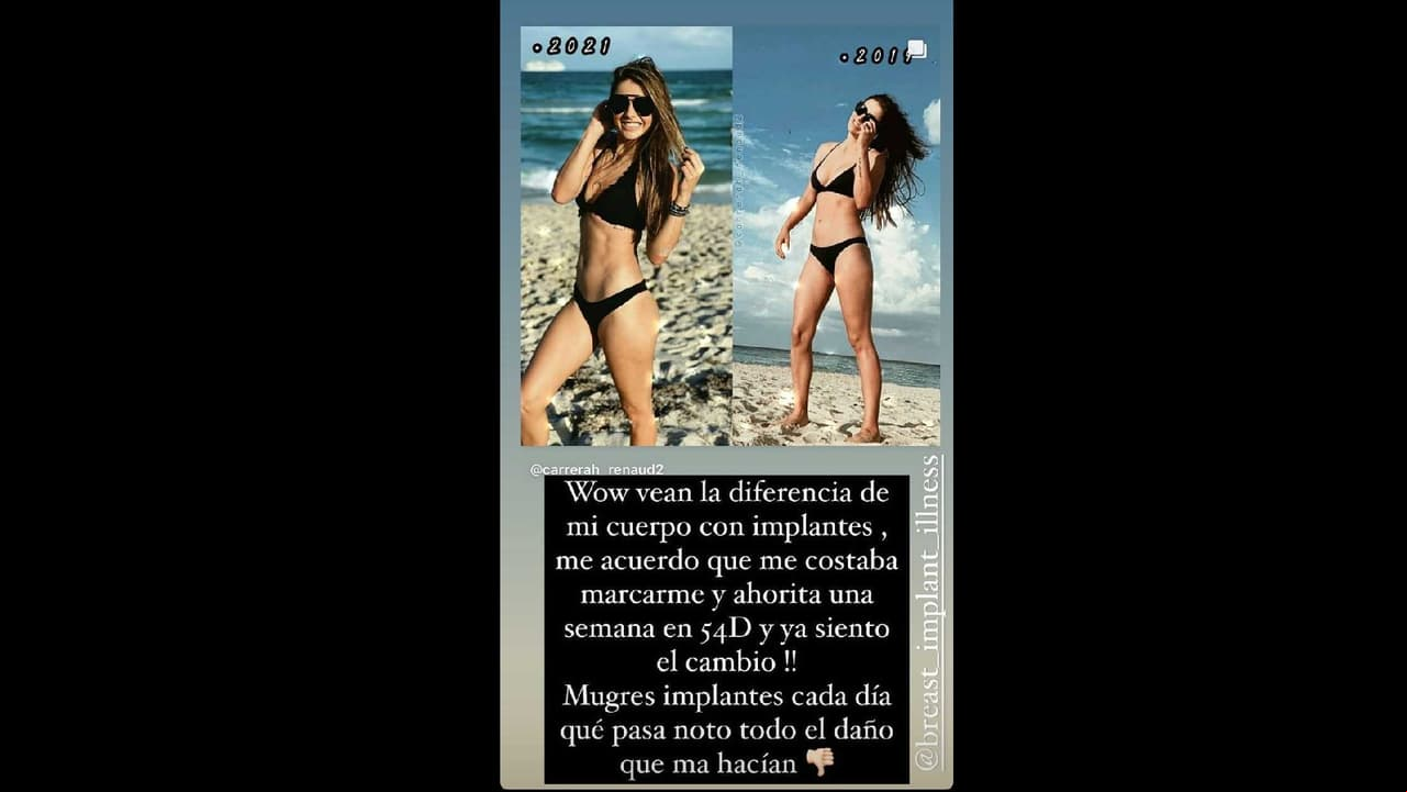 “Wow, vean la diferencia de mi cuerpo con implantes, me acuerdo que me costaba marcarme y ahorita una semana en entrenamiento y ya siento el cambio. Mugres implantes cada día que pasa, noto todo el daño que me hacían”, sentenció.